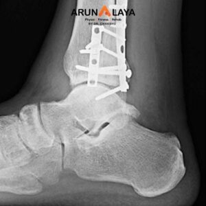 Deque Verian Post Fracture treatment at Arunalaya