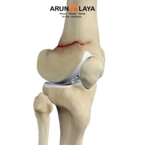 Distal femoral fracture treatment at Arunalaya