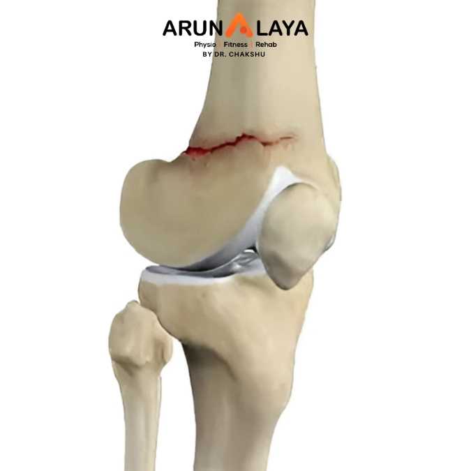 Distal femoral fracture treatment at Arunalaya