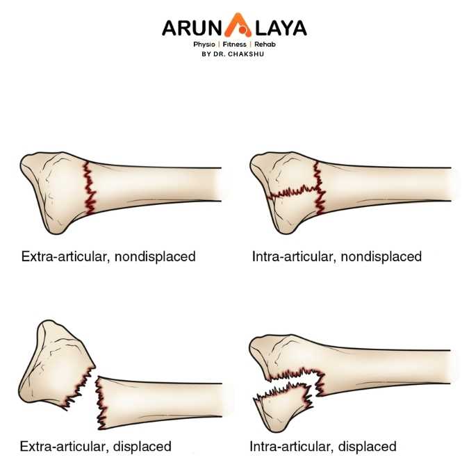 Distal radial fracture treatment at Arunalaya