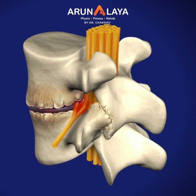 Dorsal Spondylosis treatment at Arunalaya