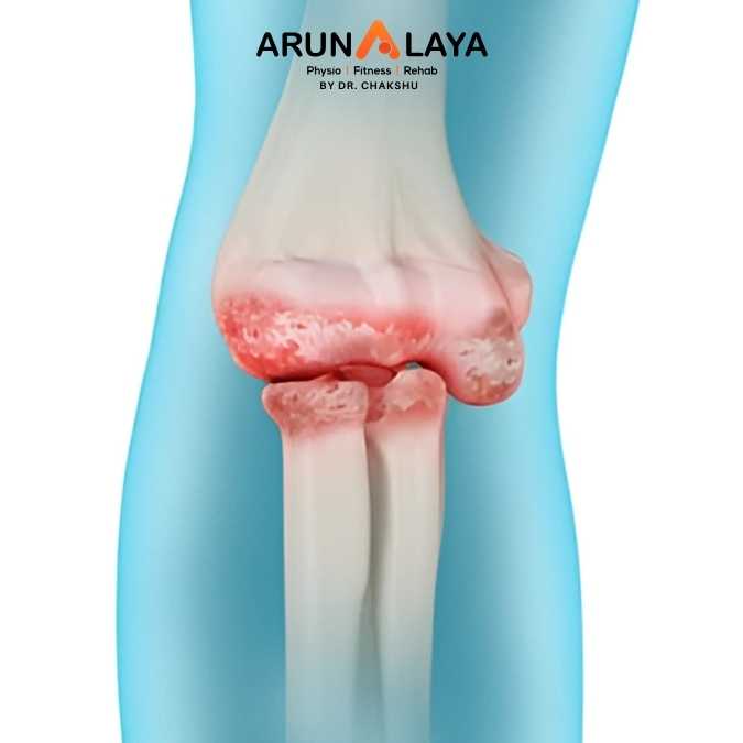 Elbow osteoarthritis treatment at Arunalaya