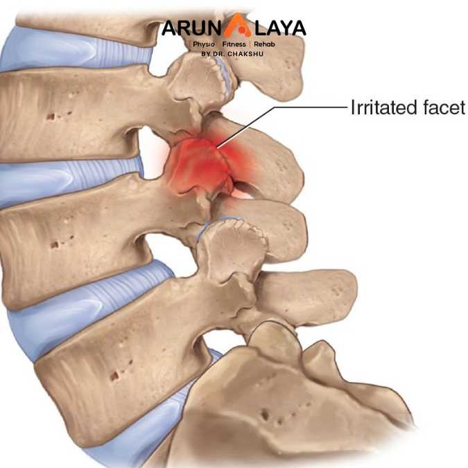 facet joint syndrome treatment at Arunalaya