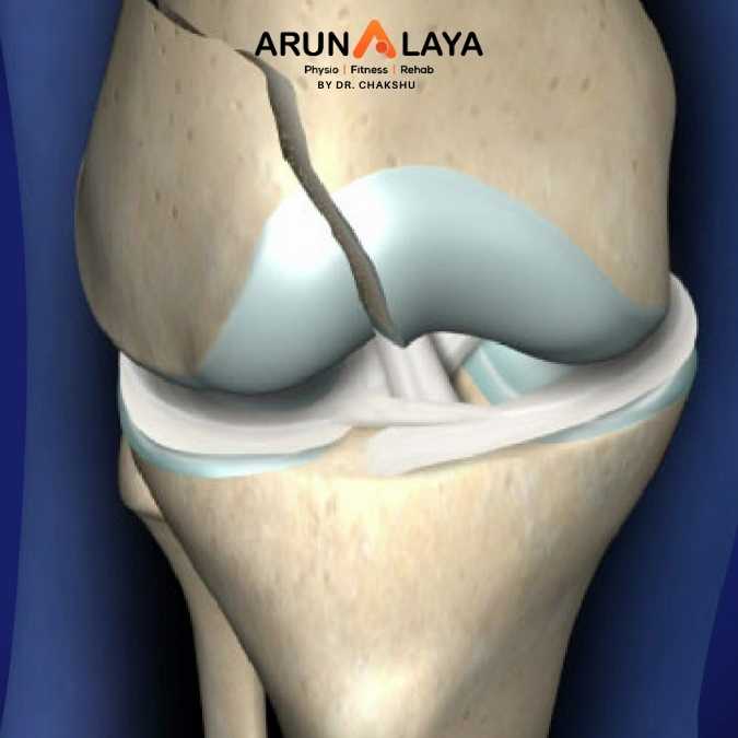 Femoral Fractures treatment and cure