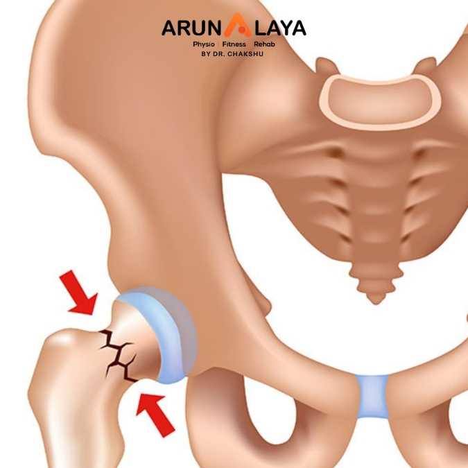 Femoral stress fracture treatment and cure