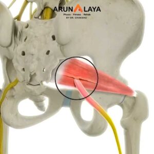 Gluteal pain syndrome treatment and cure