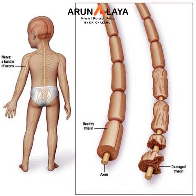 Guillian-Barre Syndrome treatment and cure