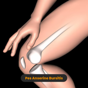 Pes Anserine bursitis