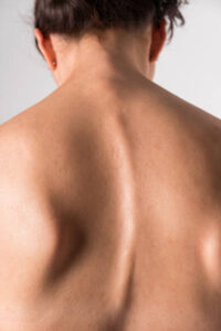 Myopathic Scoliosis