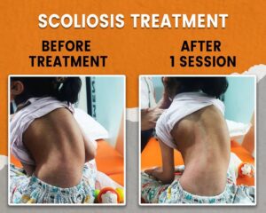 child scoliosis treatment in Delhi