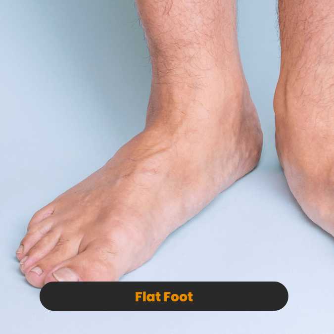 Flat foot treatment and cure at Arunalaya