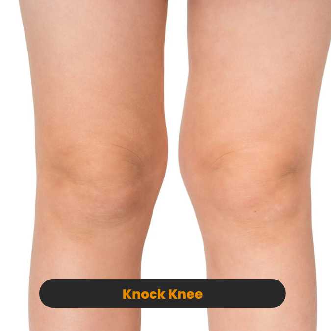 knock knees treatment and cure