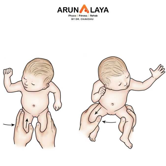 Development Dysplasia of Hip treatment