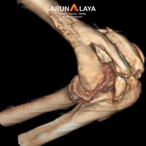 Heterotopic Ossification treatment and cure