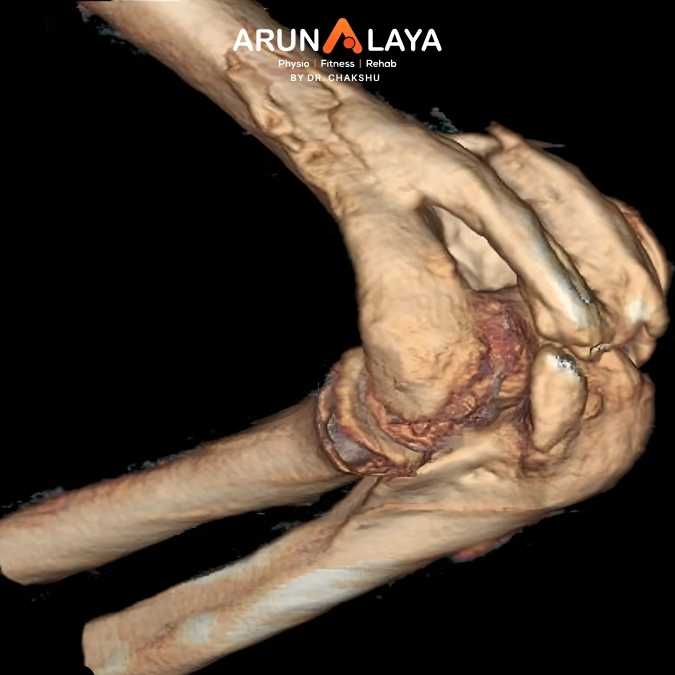 Heterotopic Ossification treatment and cure