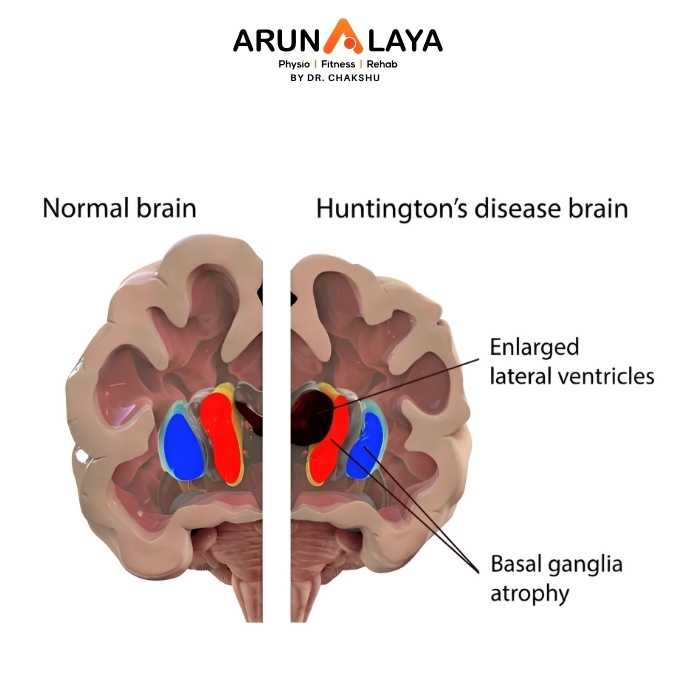 Huntington Disease treatment and cure