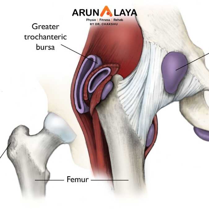 Iliopsoas Bursitis treatment and cure