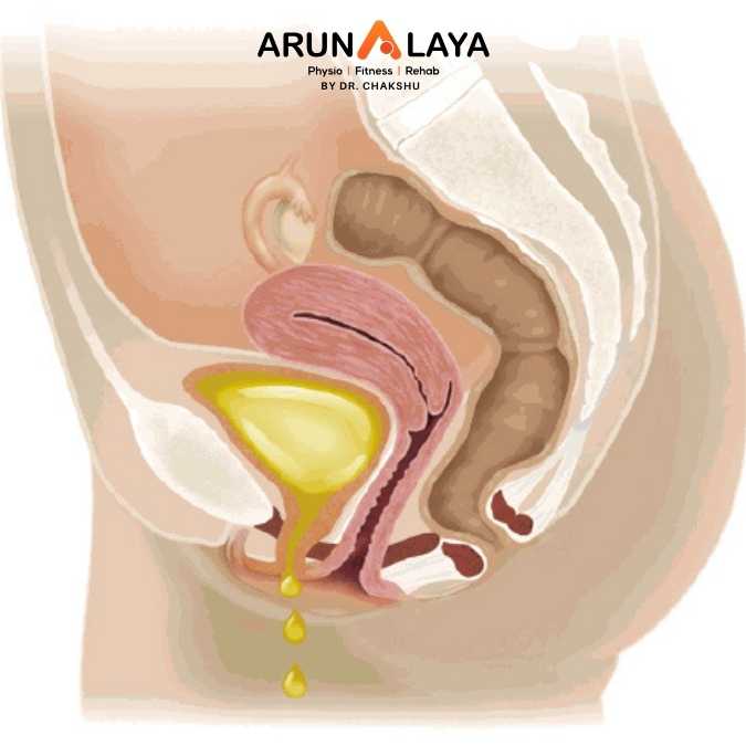Incontinence treatment and cure