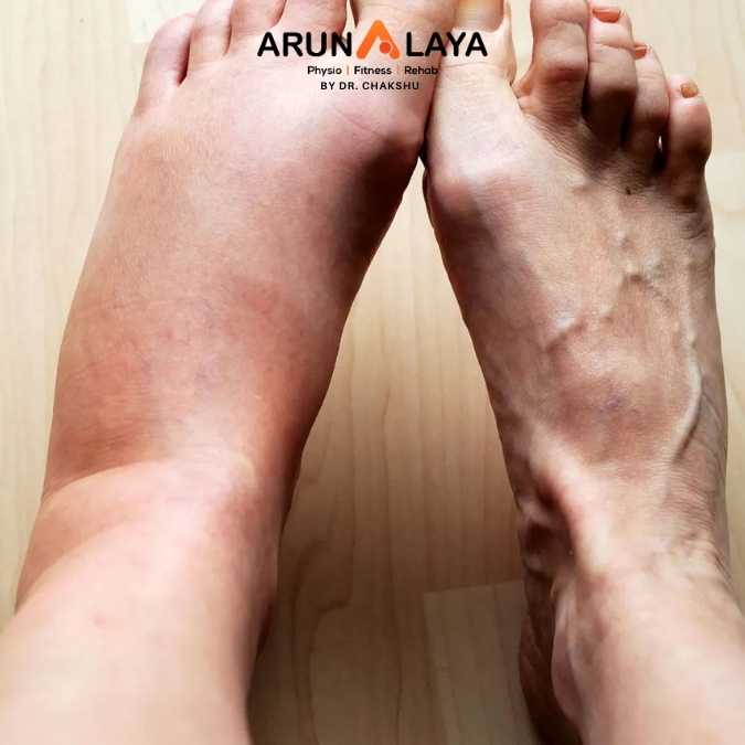 Inflammation treatment and cure