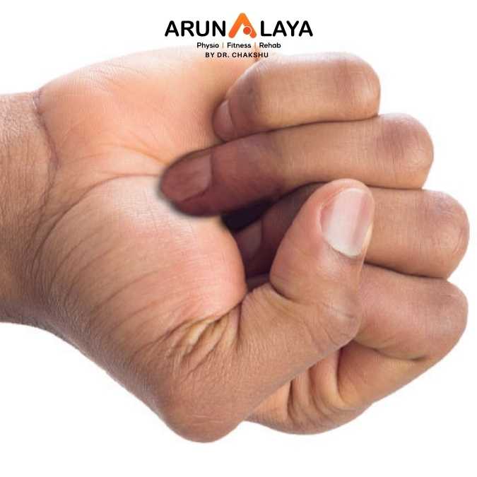 Jersey finger treatment and cure