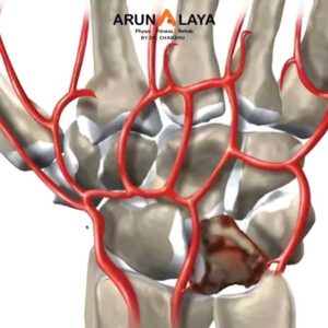 Kienbock's Disease tear treatment and cure