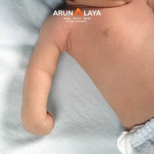 Erb Palsy treatment and cure