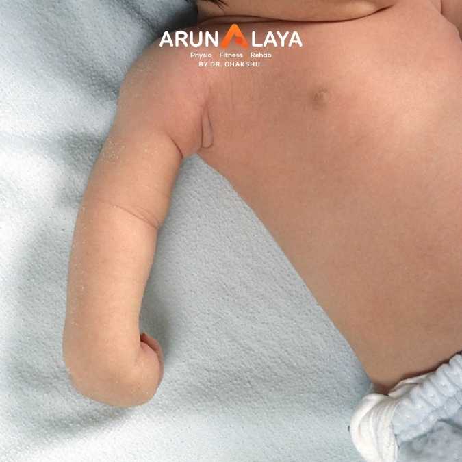 Erb Palsy treatment and cure