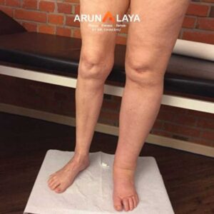 LYMPHEDEMA treatment at Arunalaya