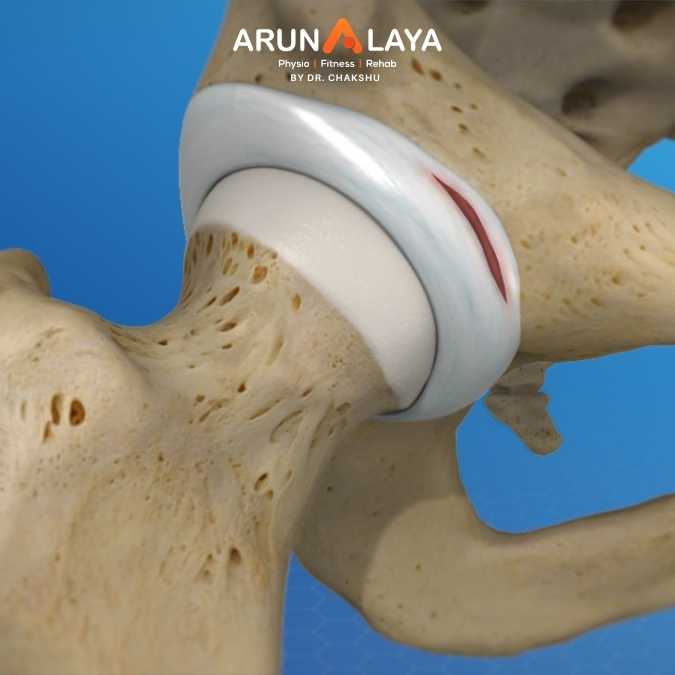Labral tear treatment and cure