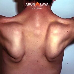 Limb Girdle Muscular Dystrophy treatment and cure