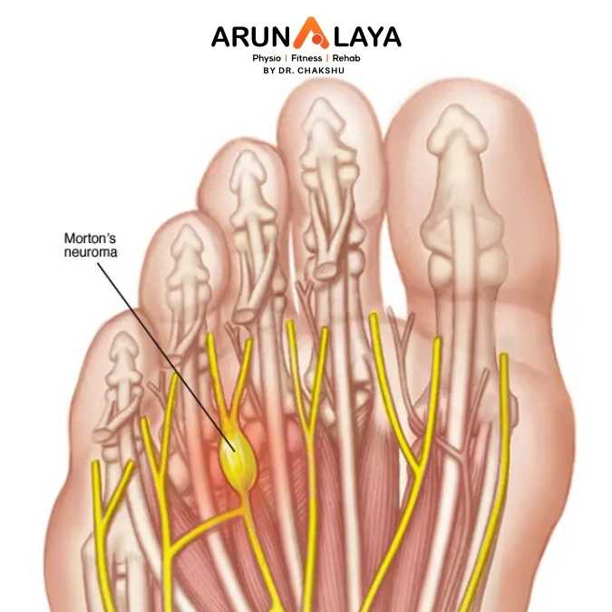 Morton’s neuroma treatment and cure