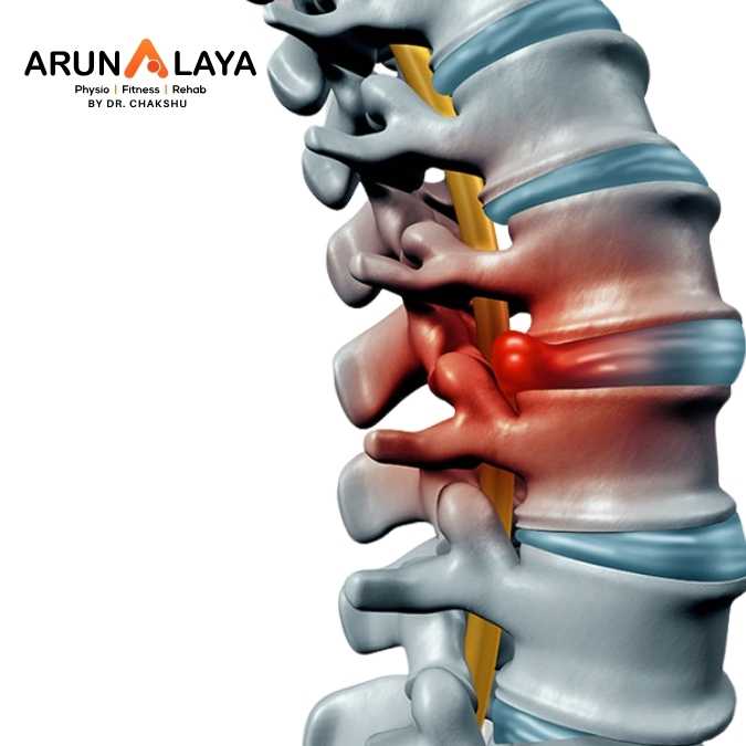 Myelopathy treatment at Arunalaya