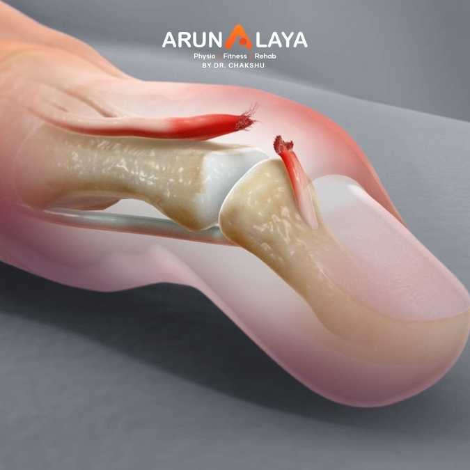 Mallet Finger treatment and cure