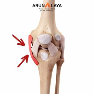 McL Tear treatment and cure