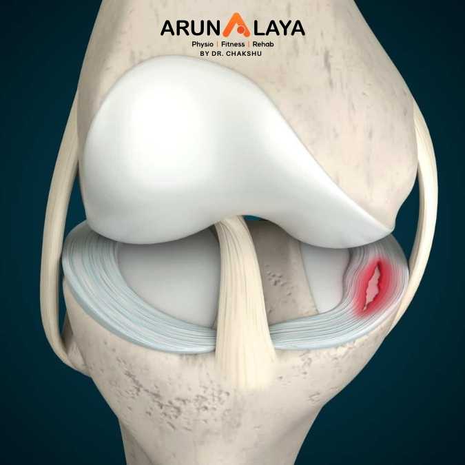 Meniscal Tear treatment and cure