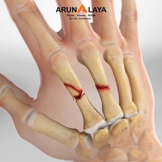 Metacarpal Fractures treatment and cure