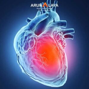 Myocardial infarction treatment at Arunalaya