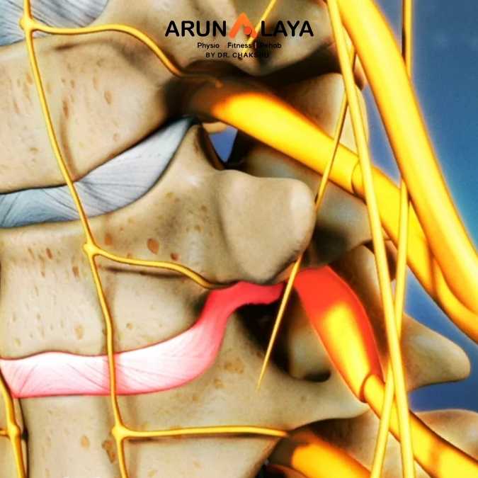 PIVD Lumbar treatment and cure