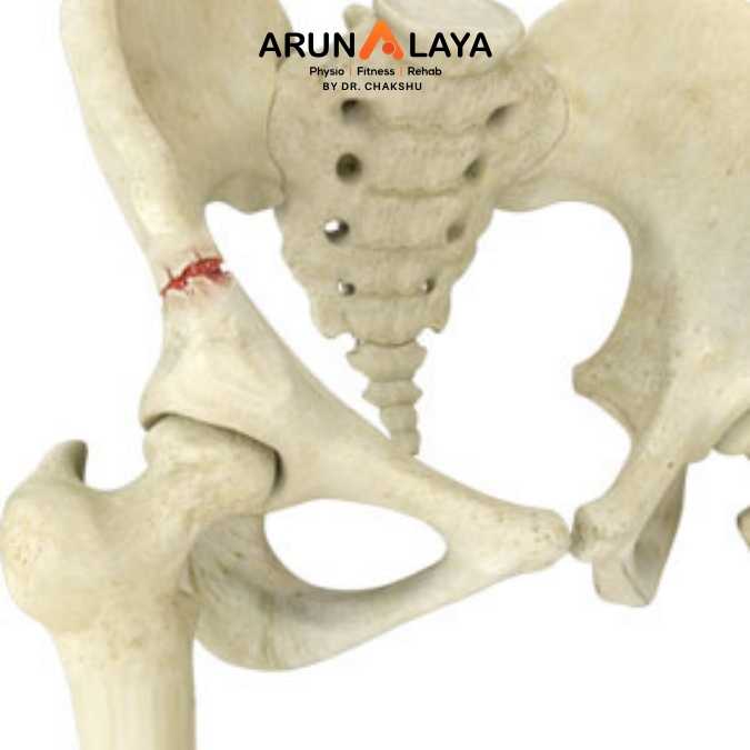 Pelvis Fracture treatment and cure