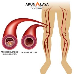 Peripheral vascular disease treatment and cure