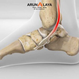 Posterior Tibial Tendon Dysfunction treatment and cure