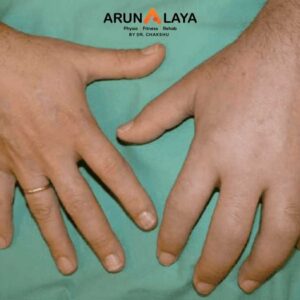 Postural Syndrome treatment and cure