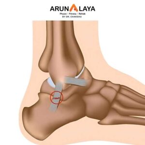 Potts fracture treatment and cure