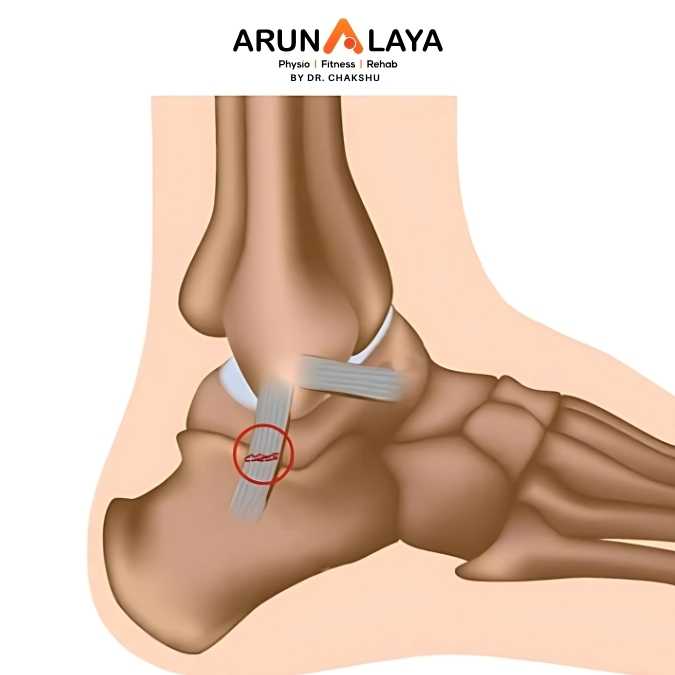 Potts fracture treatment and cure