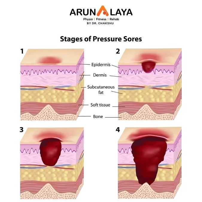 Pressure sores treatment and cure