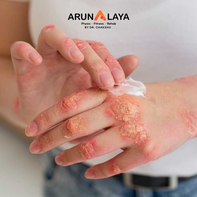 Psoriasis treatment and cure