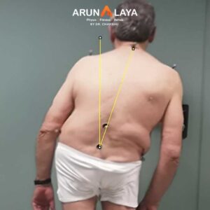 Pusher Syndrome treatment and cure