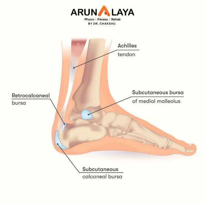 Retrocalcaneal Bursitis treatment and cure