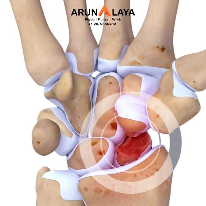 Scaphoid Fracture treatment and cure