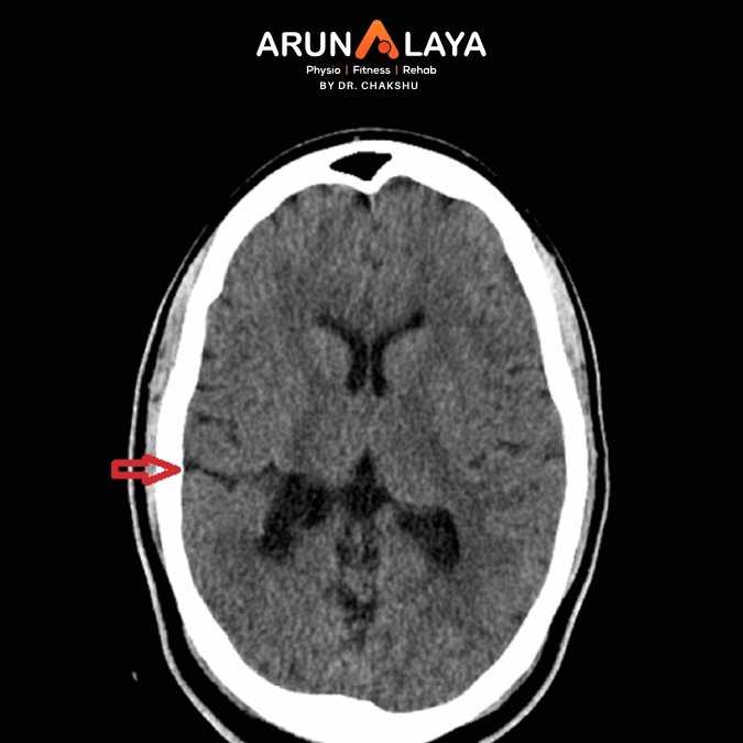 Schizencephaly treatment and cure